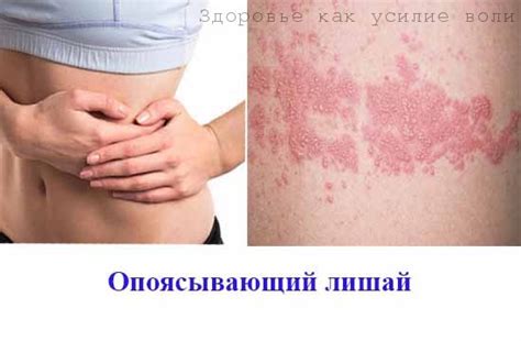Как быстро вылечить опоясывающий лишай народными средствами