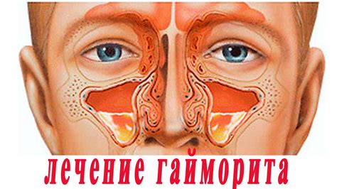 ★6 советов для лечения гайморита на дому - YouTube