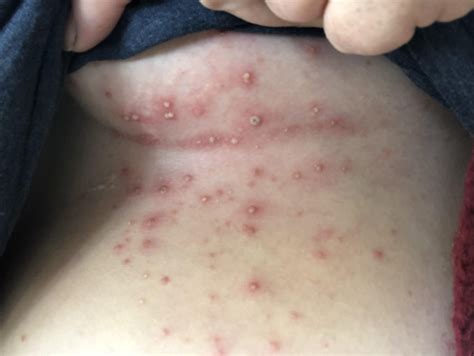 Heat Rash Chest
