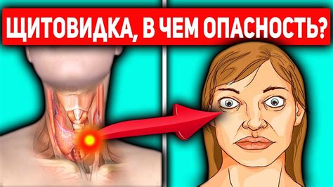 Щитовидка Придёт В Норму, Если Соблюдать Эти Простые Правила... - YouTube