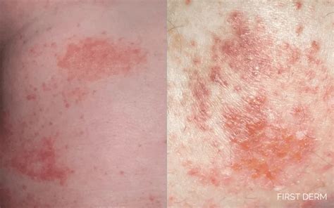 atopic dermatitis  contact dermatitis whats  difference