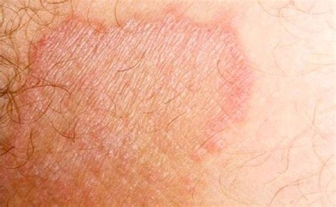 Scabies tinea cruris scabies jock itch rash - ionasse
