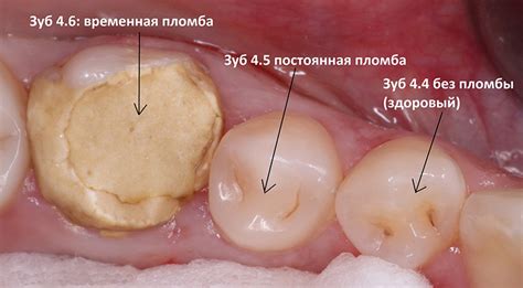 Болит зуб после установки временной пломбы