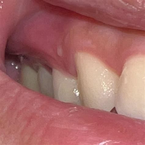 Painless circular white bump on gums, persisting for 2 months! Stayed same size. Been to 2 ...