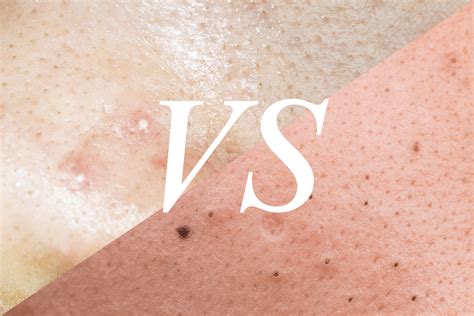 The Future of Skin Care? Unbelievable Blackhead Removal 2024 Explained - wc3oob0