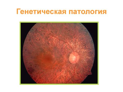 Заболевания сетчатки и зрительного нерва - презентация онлайн
