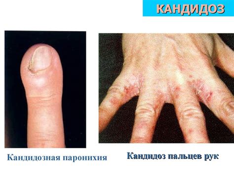 Грибковые заболевания кожи - презентация онлайн
