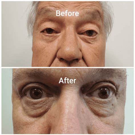 Before And After | Adam J Cohen, MD In Chicago & Glenview
