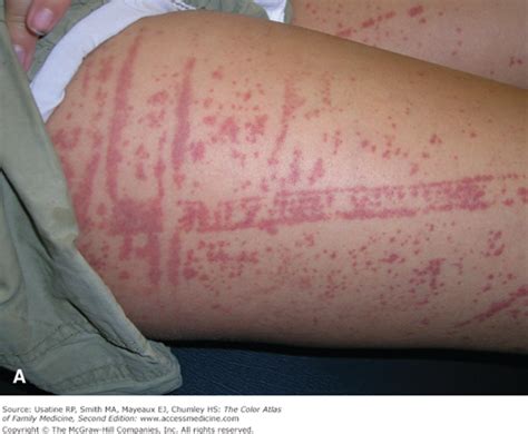 Vasculitis Lesions
