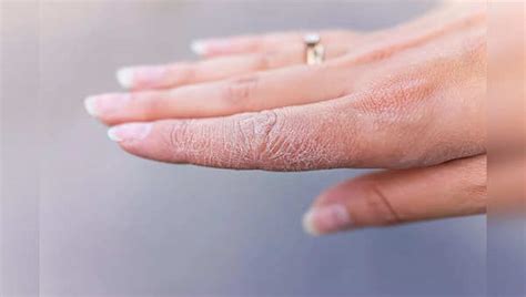 5 rare skin diseases you should know about | Health News, Times Now
