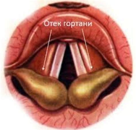 Отек гортани (ог) - признаки, причины, симптомы, лечение и профилактика ...