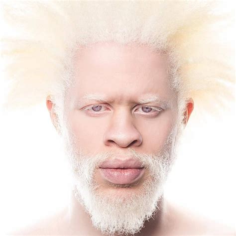 Pin on Albinism
