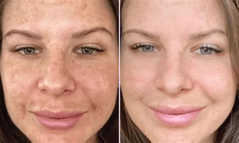 Moxi & BBL Stack | BBL Moxi Treatment - Eden Medical Clinic
