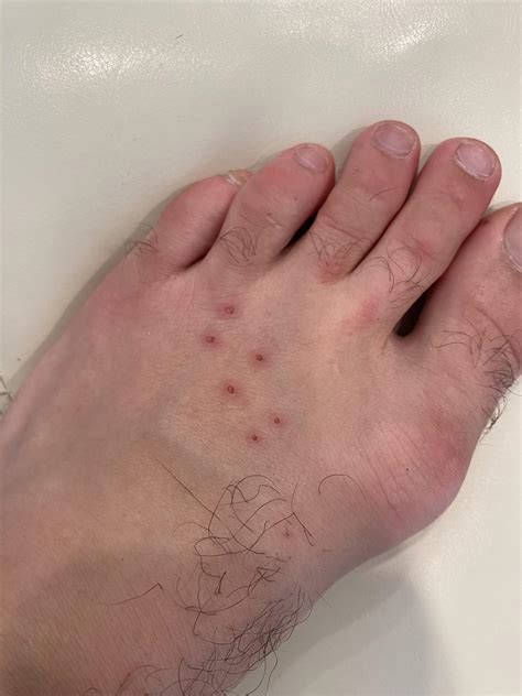 Does this look like a bat bite? : r/rabies