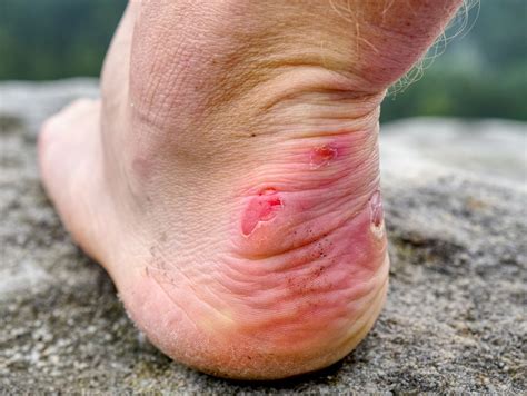 wound care blisters  karen spaulding blog