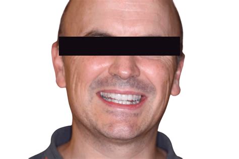 Smile Transformations Gallery | Jax Dental Arts