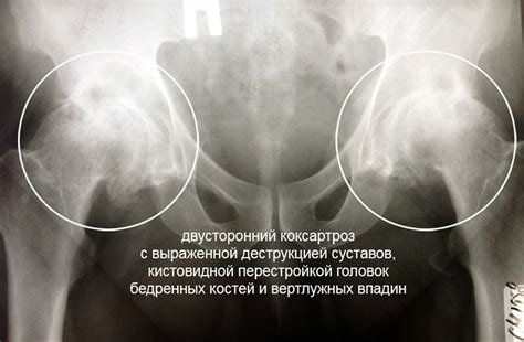 Артроз тазобедренного сустава: симптомы и лечение, причины, диагностика