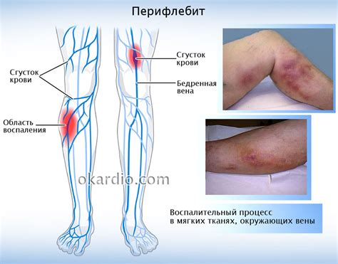 Флебит нижних конечностей: симптомы и лечение, причины, виды патологии