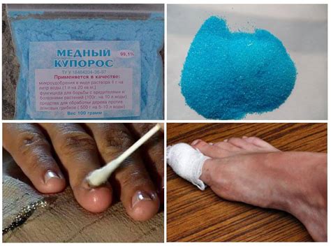 Народное средство от грибка на ногах - методы быстрого лечения ...