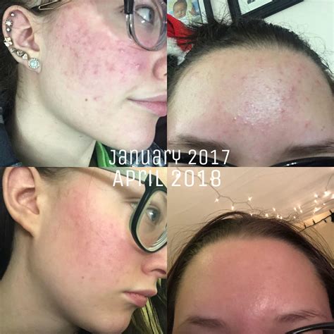 [B&A] Happy with my transformation so far, but would love to improve my