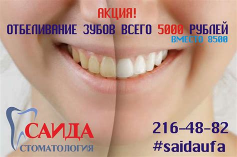 Безопасное и эффективное отбеливание зубов - САИДА - клиника стоматологии