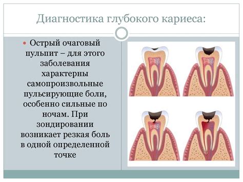 Глубокий кариес - презентация онлайн