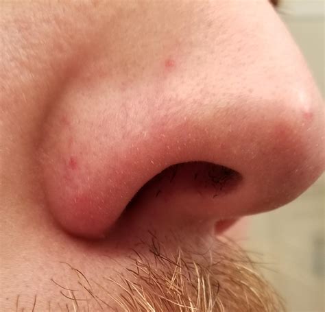 Sensitive Nose Skin at Nancy Sheridan blog