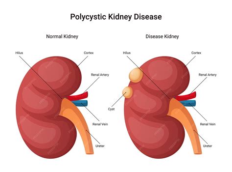 Qual A Porcentagem De Um Rim Normal - Infográfico de doença renal policística, rim normal e ilustração de ...