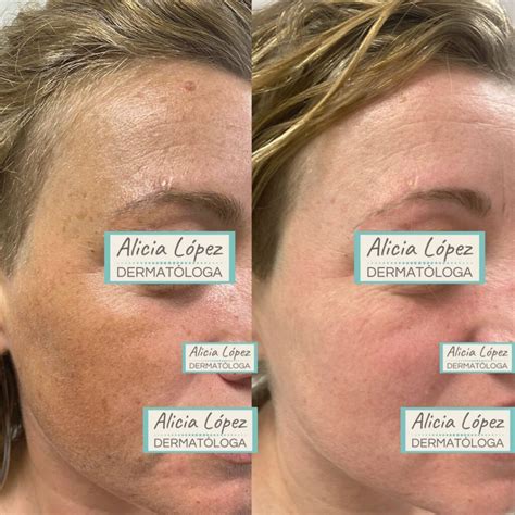Luz Pulsada Rosto Antes E Depois - Fotorrejuvenecimiento con luz pulsada intensa: te cuento todo - Dermamurcia