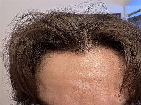 Diffuse thinning? : r/malehairadvice