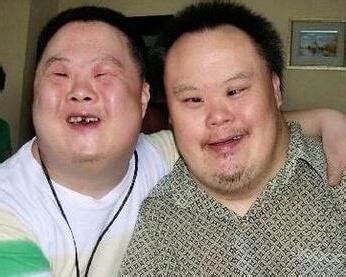 唐氏综合征 - 搜狗百科