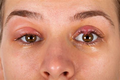 bump  eye bumps  eyeball  types  treatment xijmh