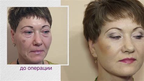 Подтяжка лица - невероятный результат! Пластическая операция до и после ...