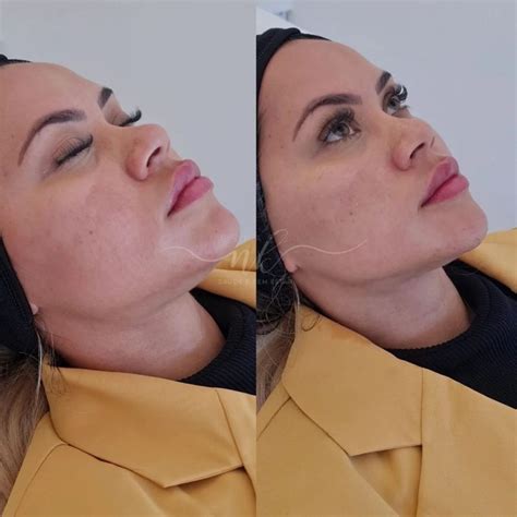 I tried HIFU facial laser to minimise my double chin
