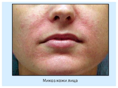 Микозы. Классификация