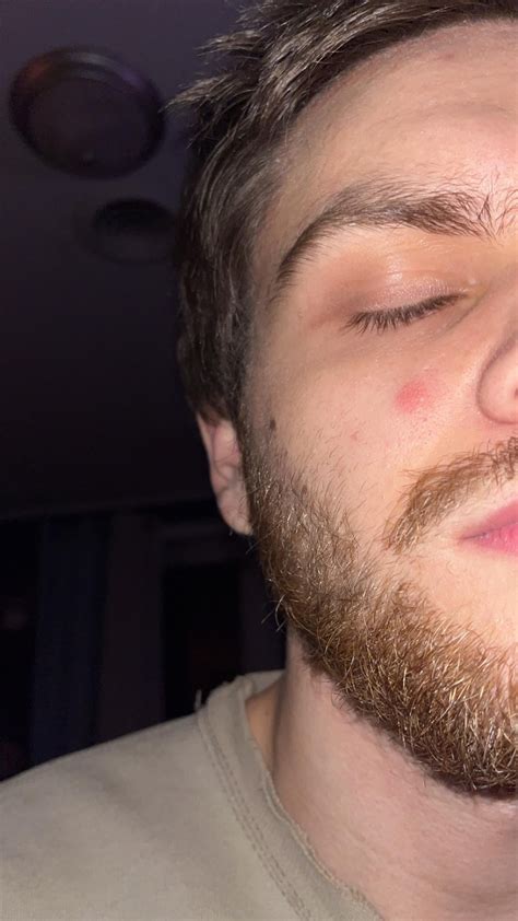 Red scaly patches of skin (mostly small circles except corners of my