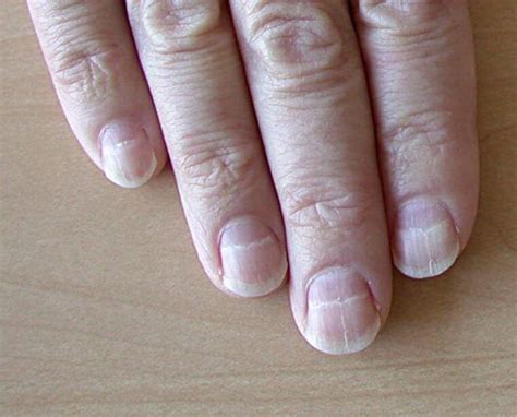 Вмятины на ногтях - 100 фото примеров и советы как удалить вмятины на ...