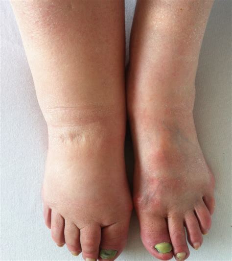 LEG SWELLING: CAUSES, RISKS, AND VENOUS DISEASES | Supreme Vascular and Interventional Clinic