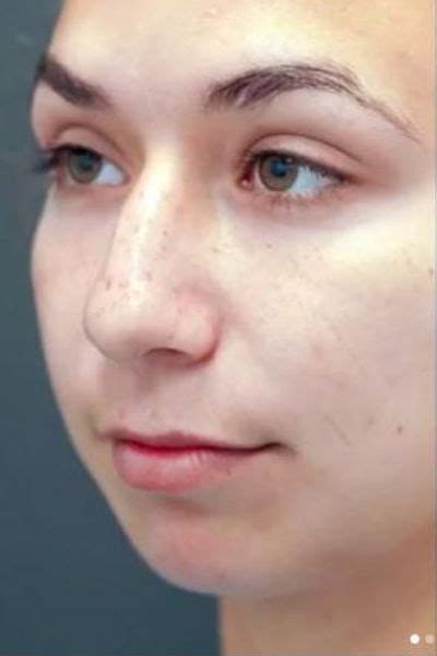 chin augmentation case  roseville facial plastic surgery