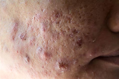 Acne Nodular Pop Should You Pop Pimples? A Dermatologist Weighs In