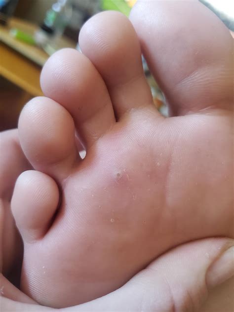 Splinter on the bottom of my foot. Starting to hurt to walk on 😪 help