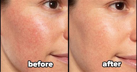 Rosacea Treatment Cream Aco 100% Originalused | www.oceanproperty.co.th