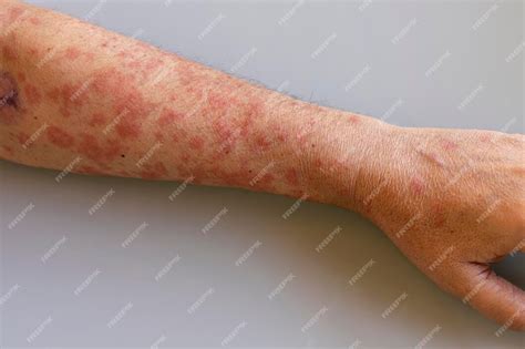 Virose Da Mancha No Corpo - Braço do homem com manchas na pele do vírus do herpes | Foto Premium