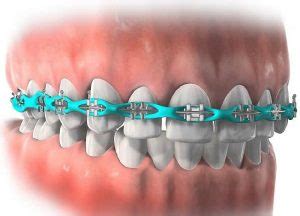 Orthodontic Power Chain Braces Before & After, Types, Use, Care, Pain & More - Healthrow.net