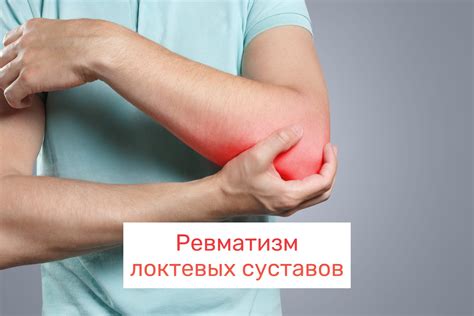 Ревматизм локтевых суставов: что это, симптомы и лечение