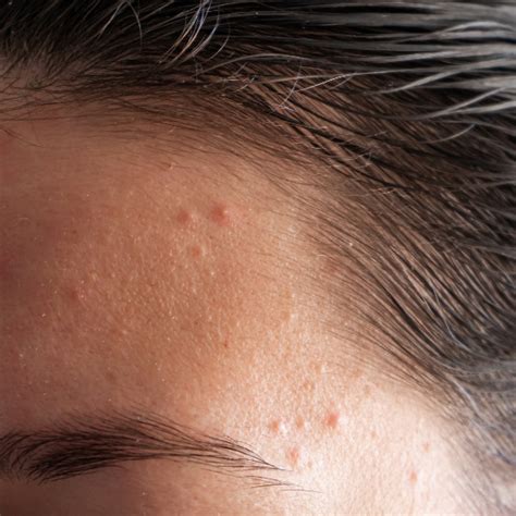 recognising  caring  blemished skin pure skin food