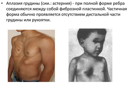 Аплазия ключицы - презентация онлайн