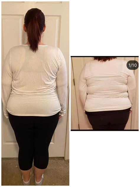 BACK GAINS 😍 4 months post-op | Scrolller