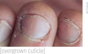 Why are my cuticles peeling? - Dérmica MedEsthetics