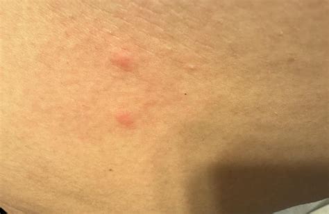 Bites on Skin : r/DermatologyQuestions